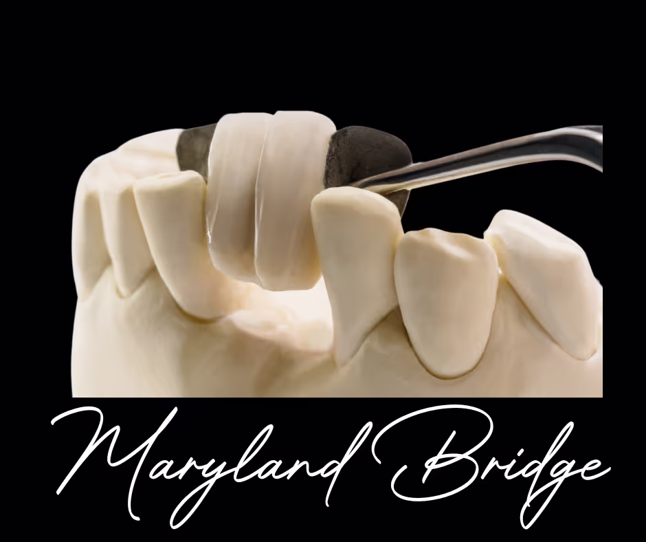 Display of a maryland dental bridge