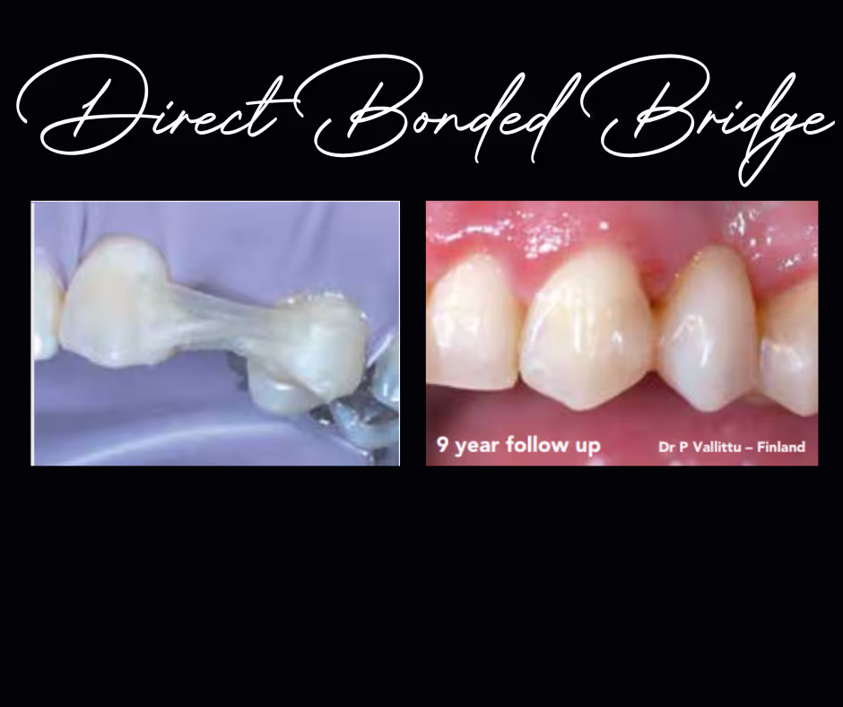 Picture of direct bonded dental bridge