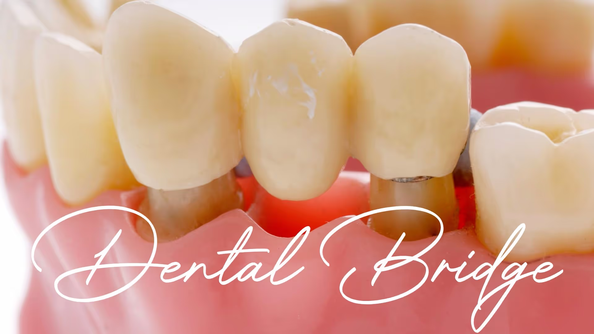 Picture of a dental bridge