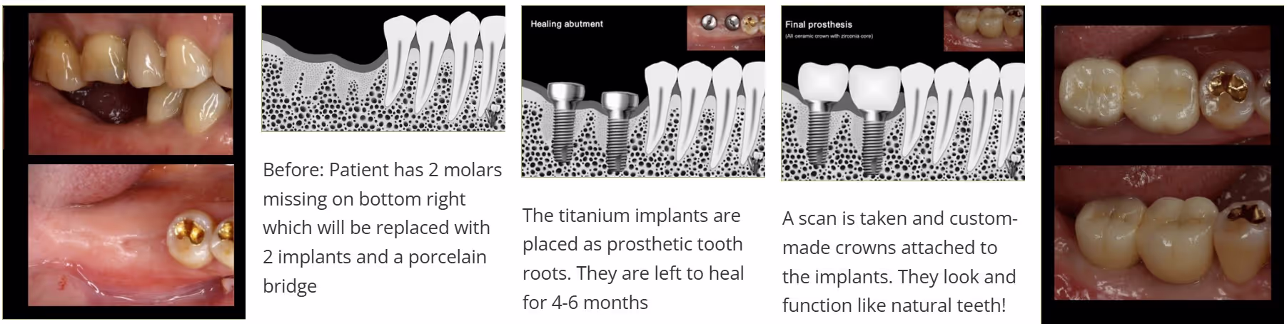 Demonstrations of where dental implants will help a patient