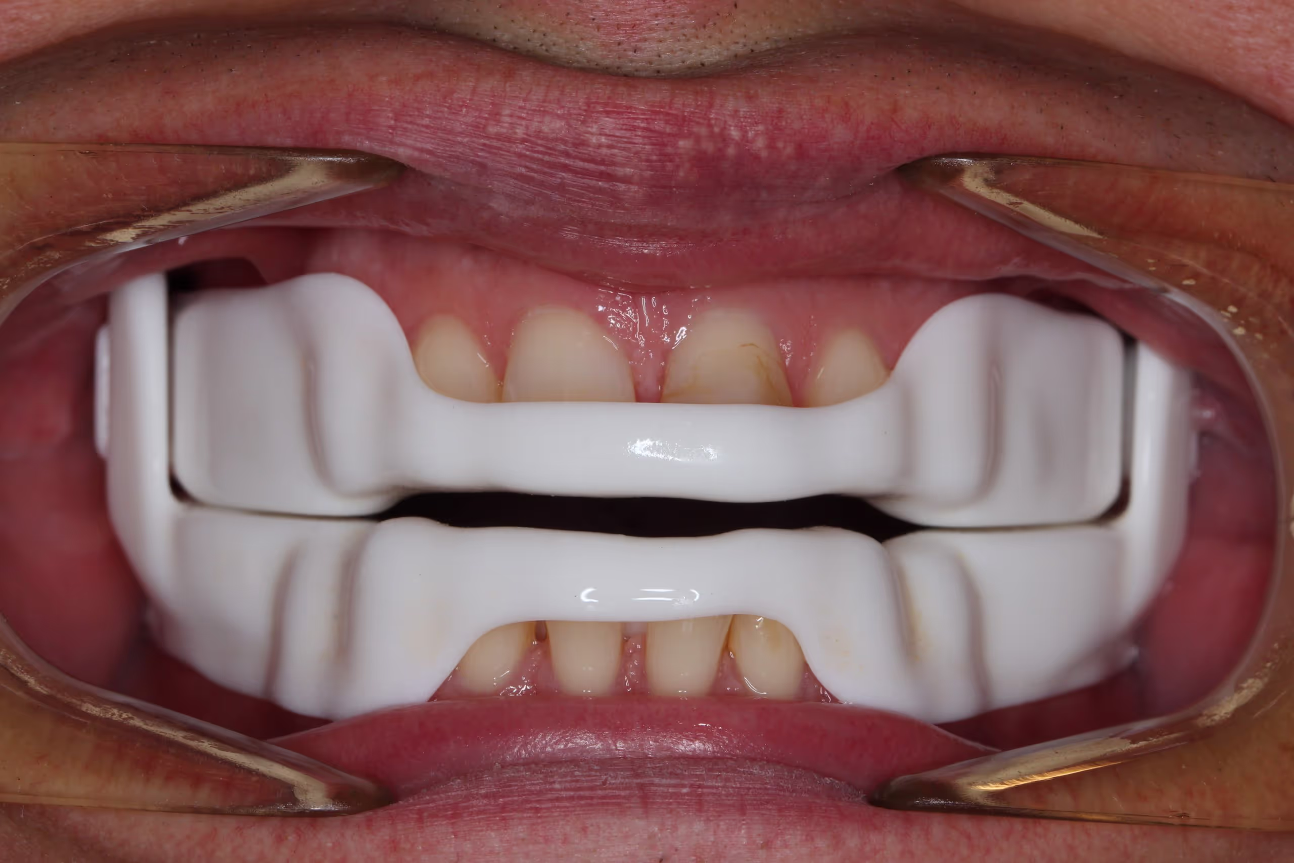 A dental splint