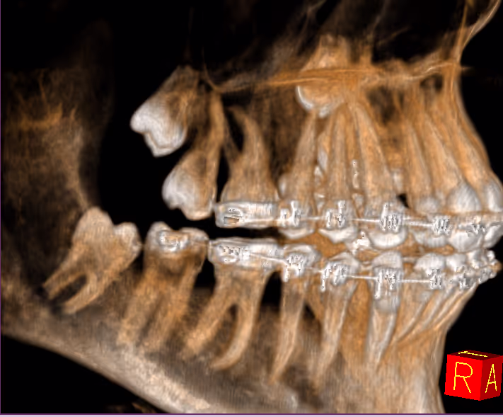 Xray of teeth showing wisdom teeth