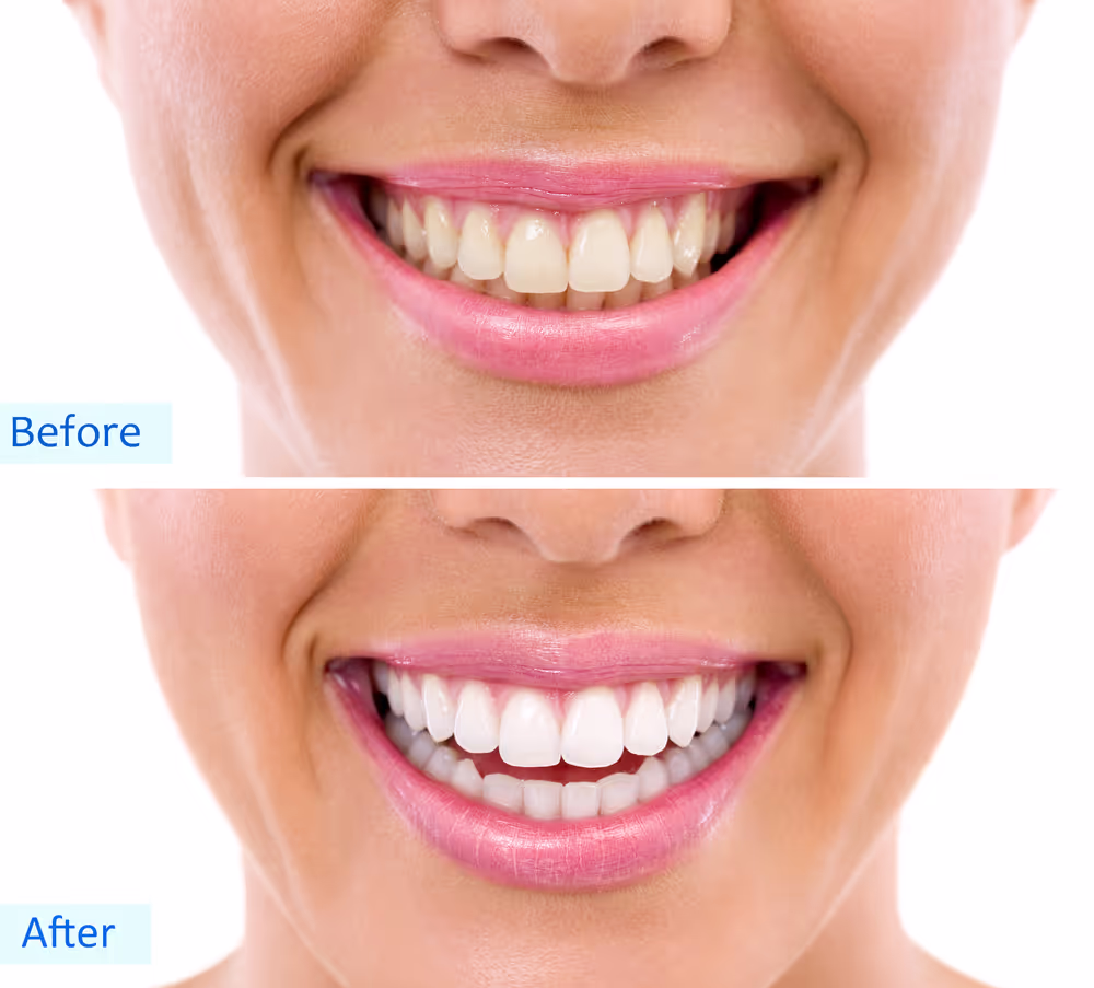 Tooth whitening before and after