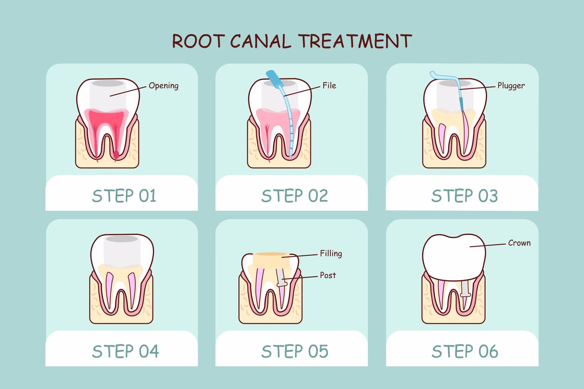Root canal treatment illustration