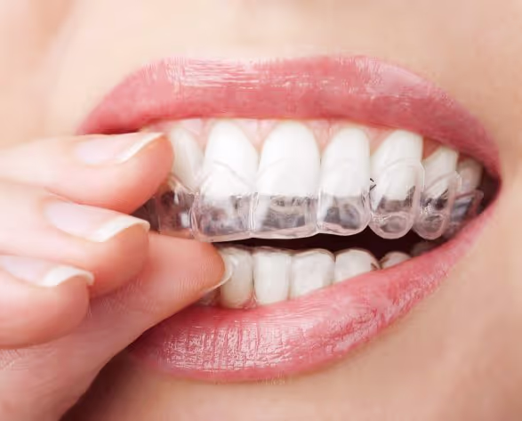 Invisalign clear aligners on teeth