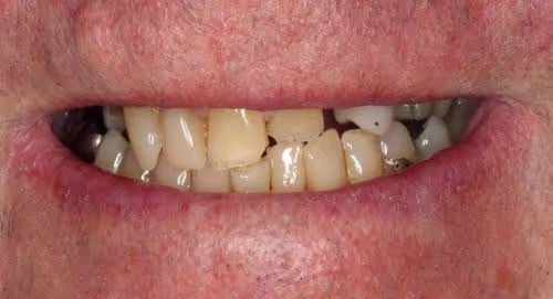 Before and after of worn down teeth treatment