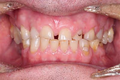 Before and after of worn down teeth treatment