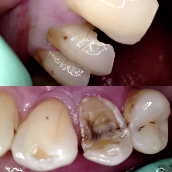 Before and after of worn down teeth treatment