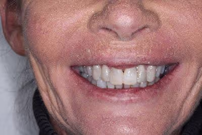 Before and after of worn down teeth treatment
