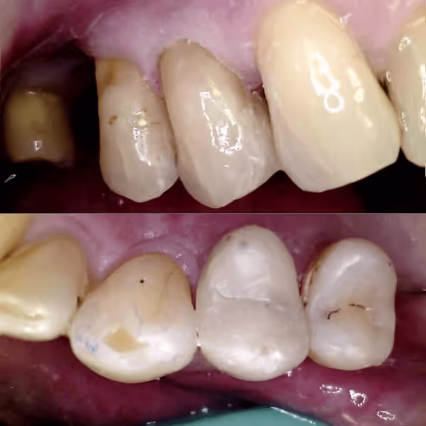 Before and after of worn down teeth treatment
