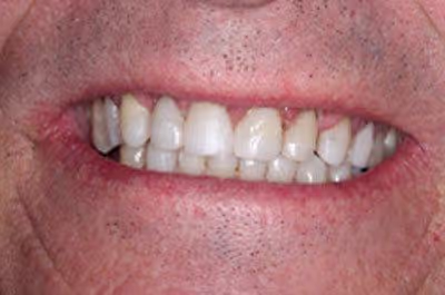 Before and after of worn down teeth treatment