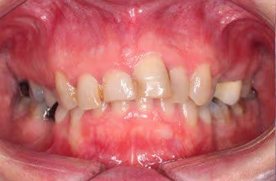Before and after of worn down teeth treatment