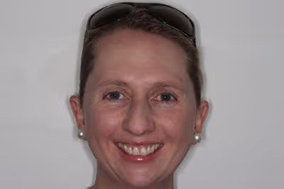 Before and after of worn down teeth treatment