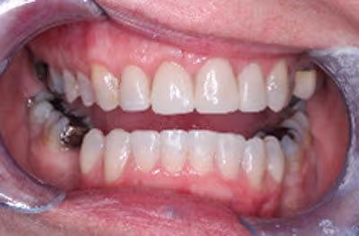 Before and after of worn down teeth treatment