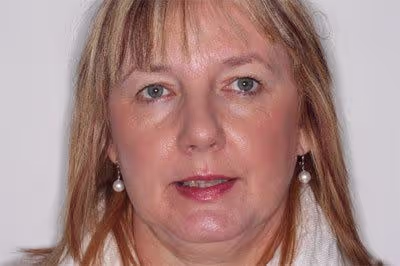 Before and after of worn down teeth treatment