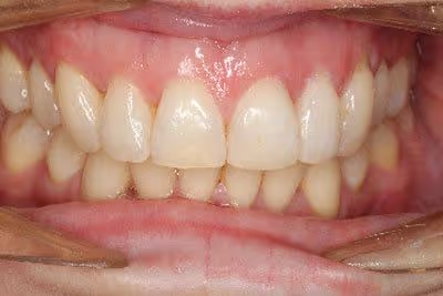 Before and after of worn down teeth treatment