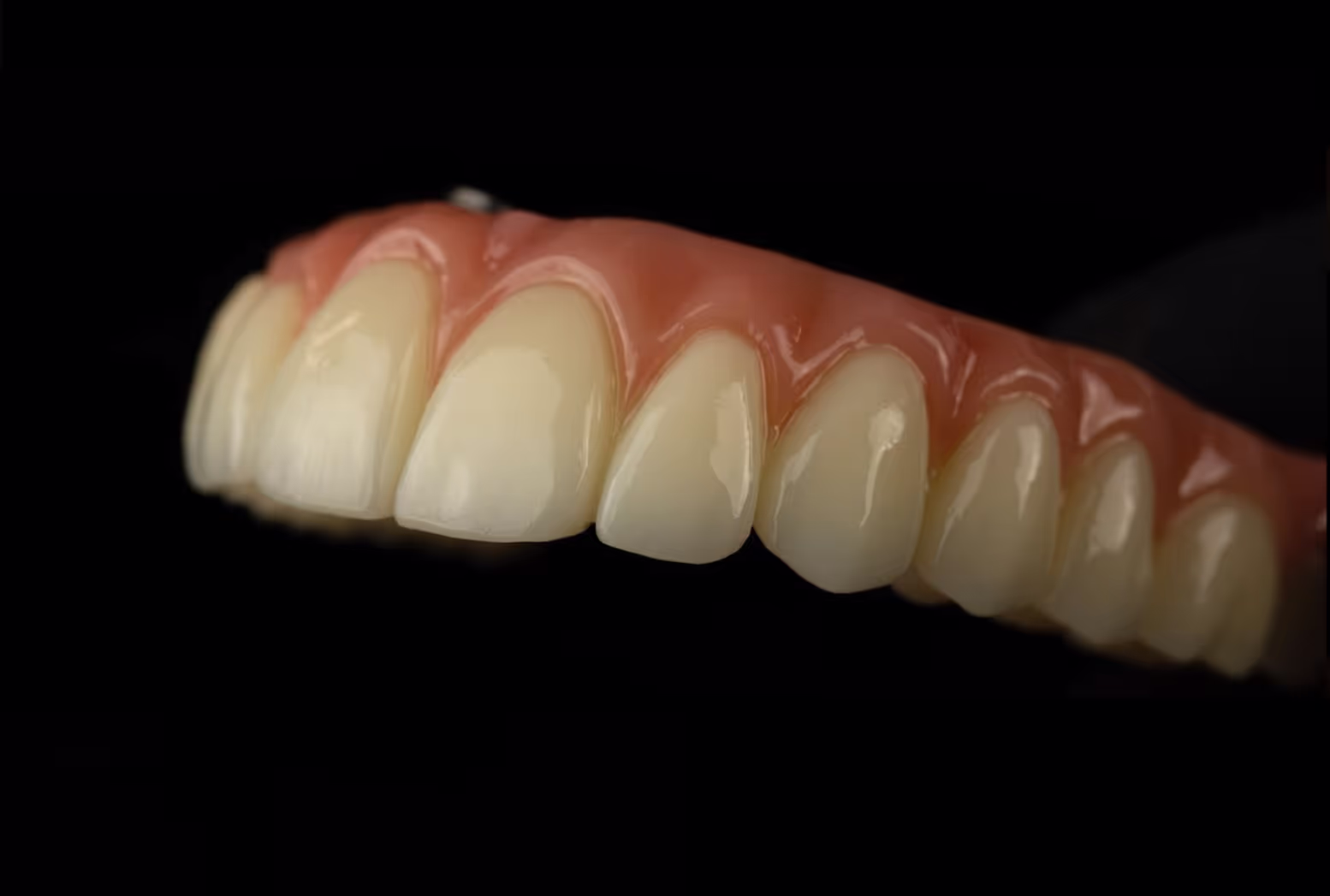 All on X top row implant
