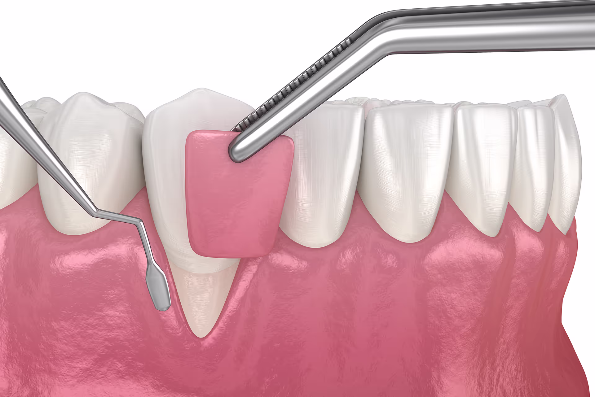 Illustration of gum recession coverage