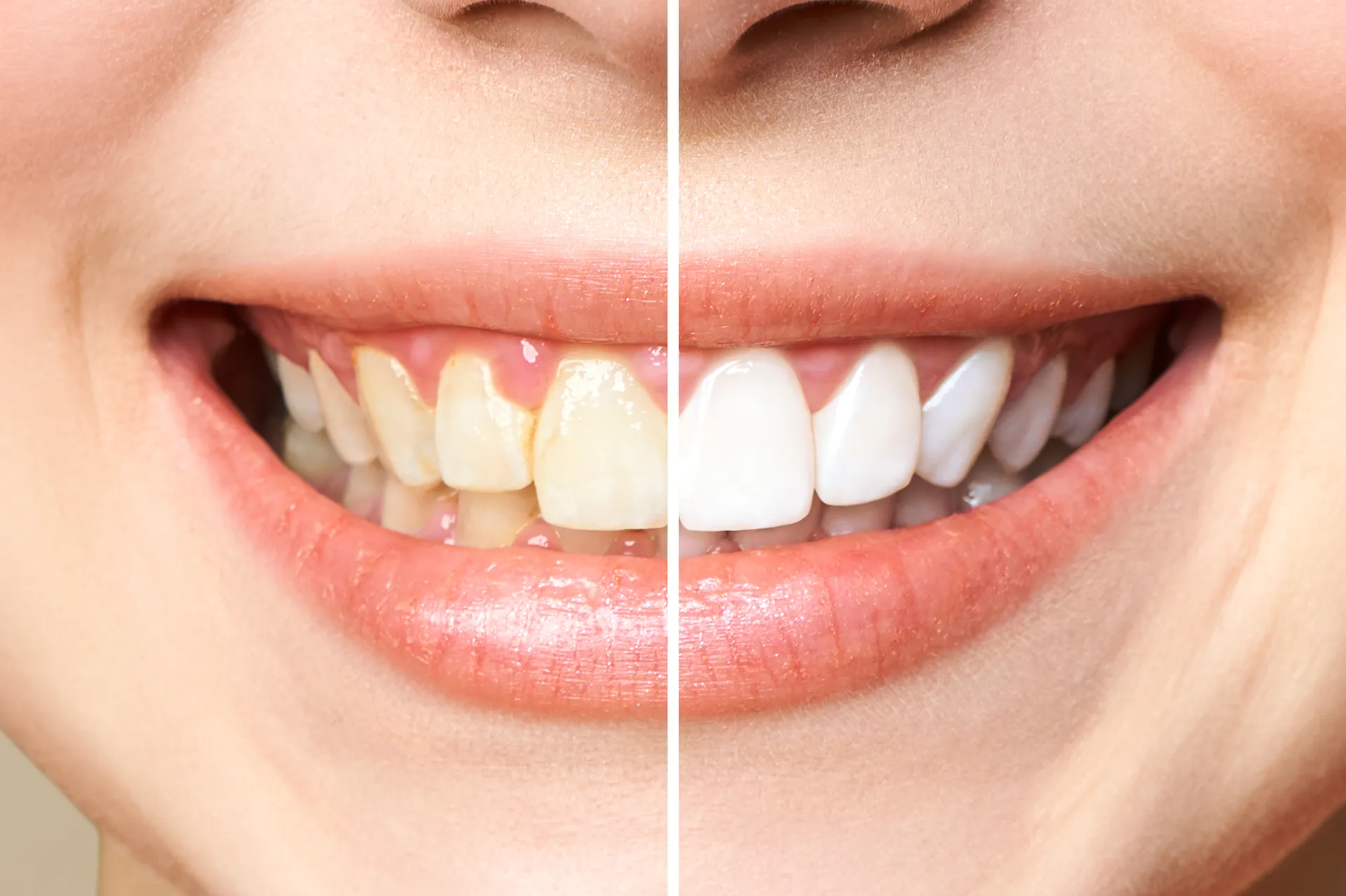 Tooth whitening before and after