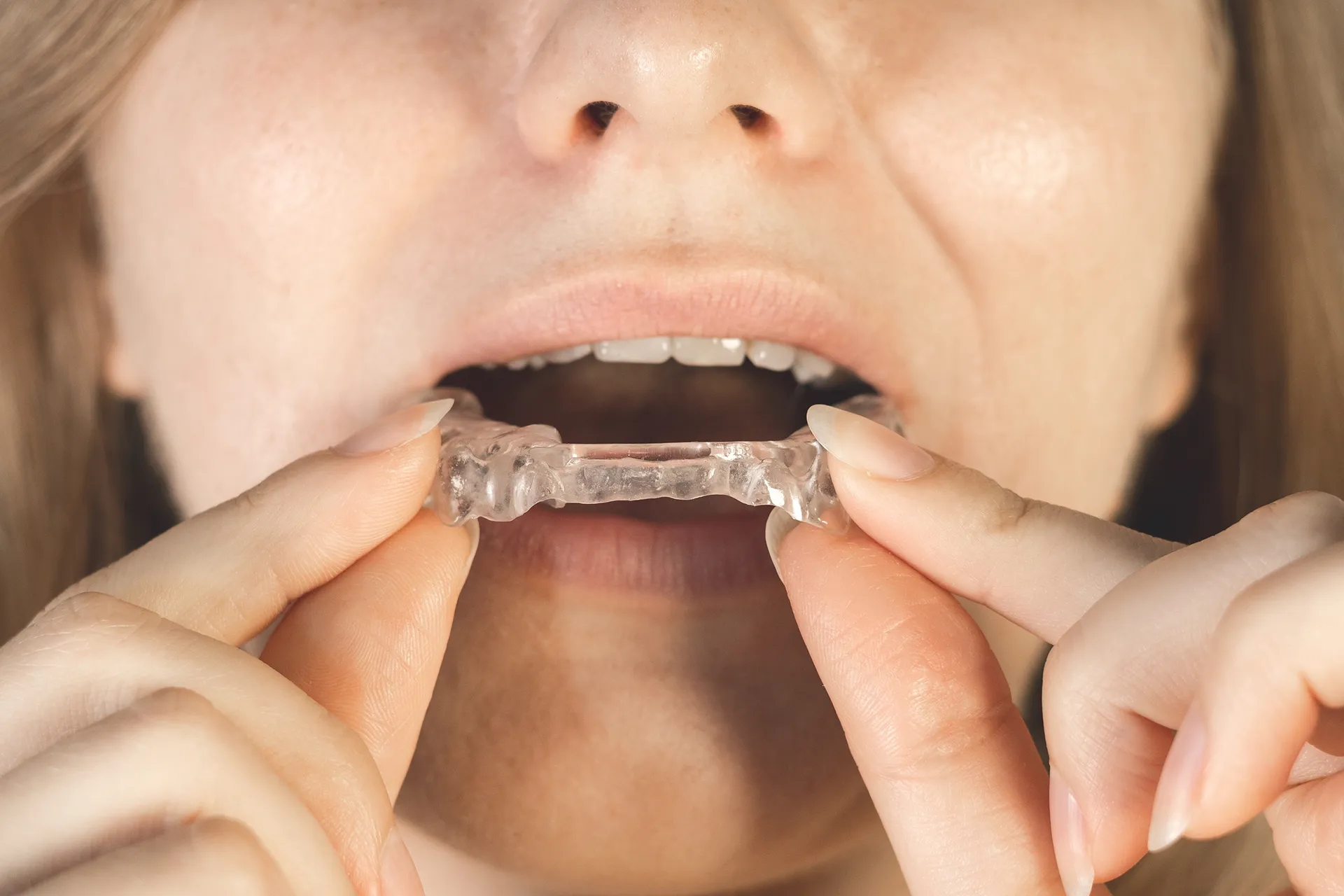 A woman putting a clear retainer in