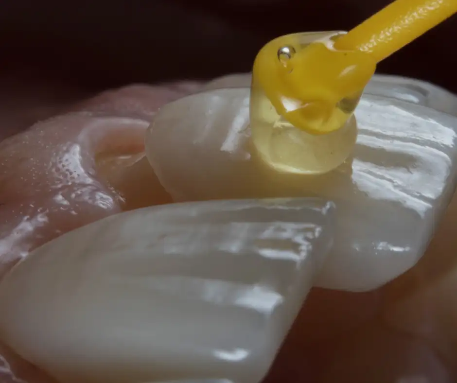 Dental implant with crown being put on