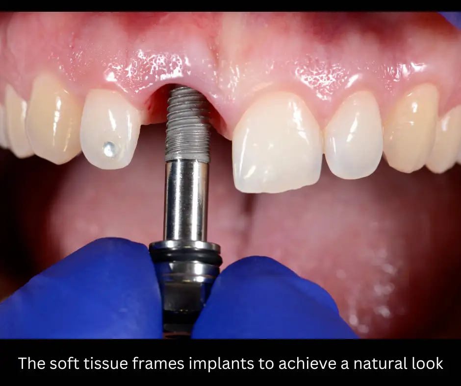 close up of a dentist screwing in a dental implant