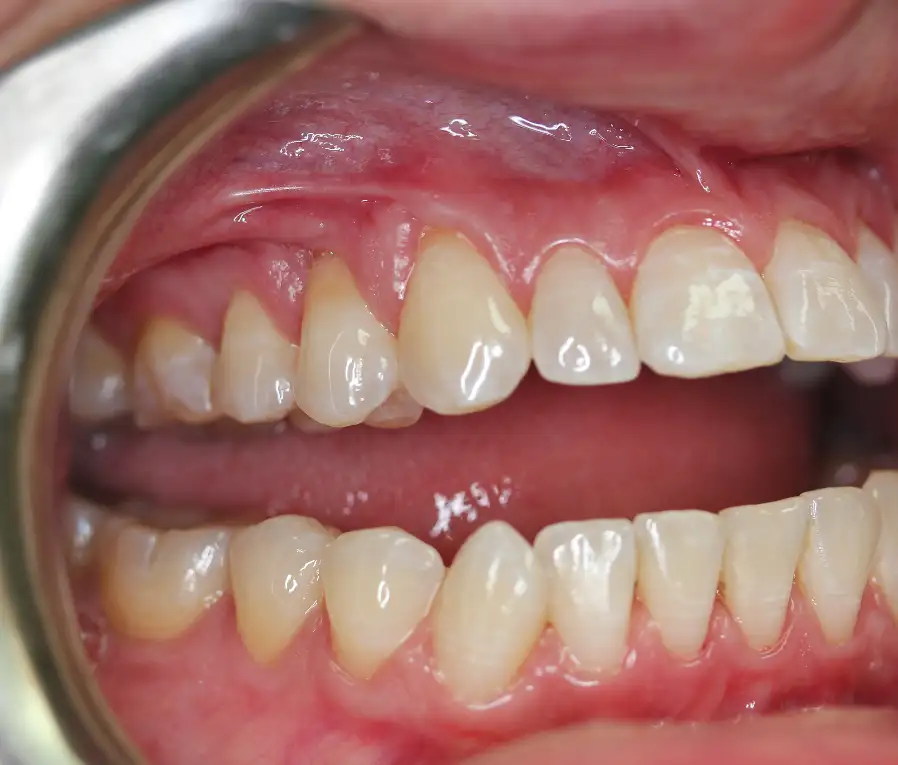 Close up of gum recession