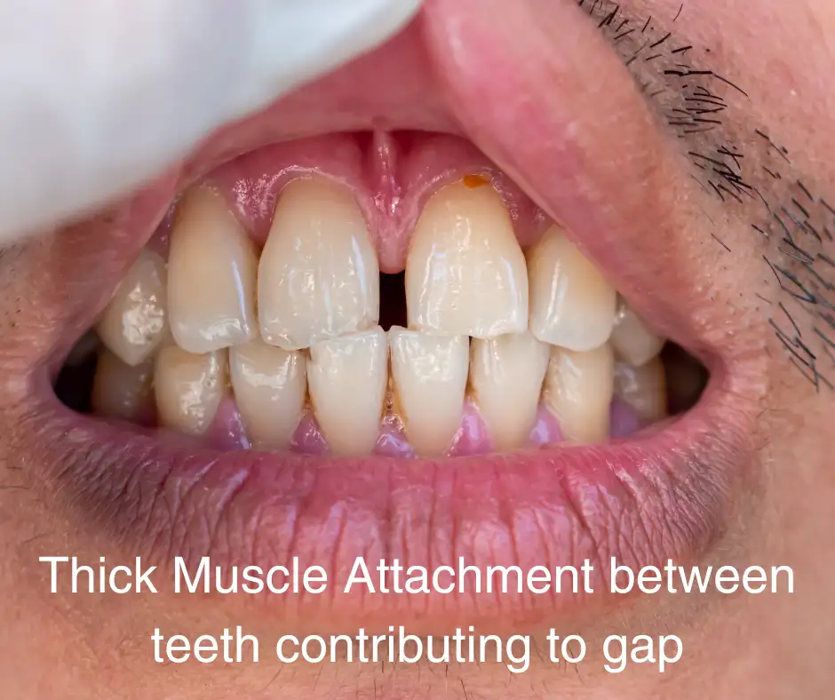 close up of labial and buccal frenum in male's mouth