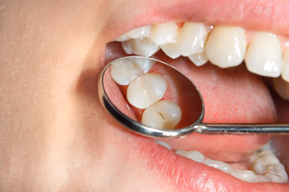 Up close showing dental decay cavity in tooth