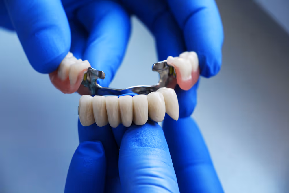 Tooth model displaying dental bridges
