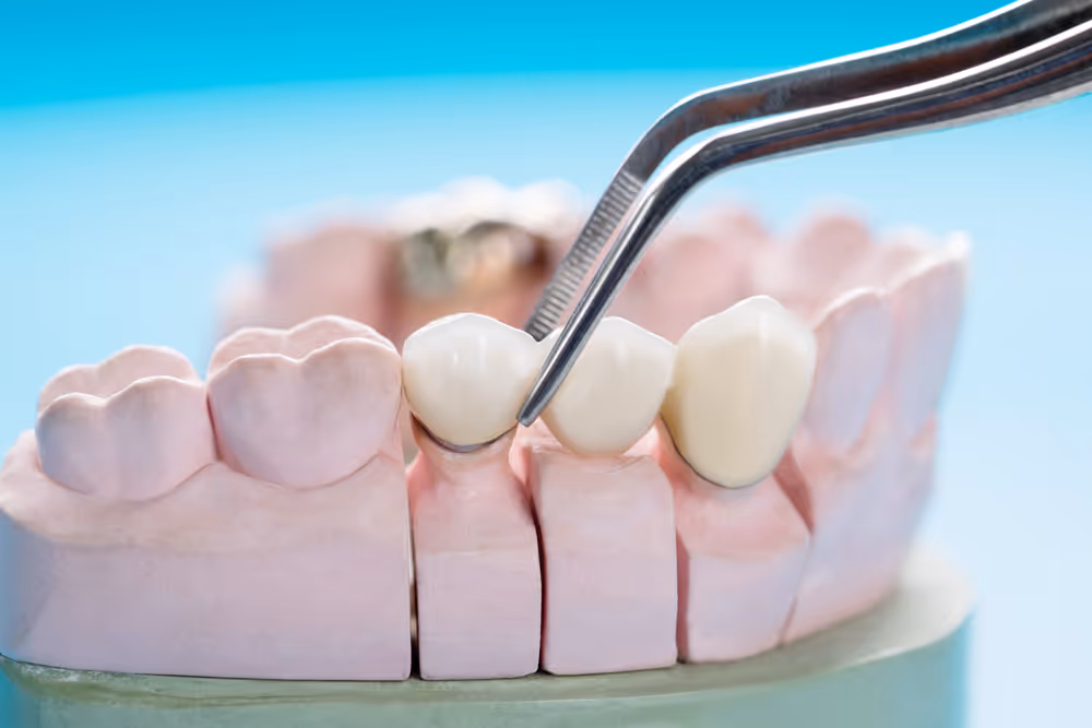 Tooth model demonstrating dental bridges