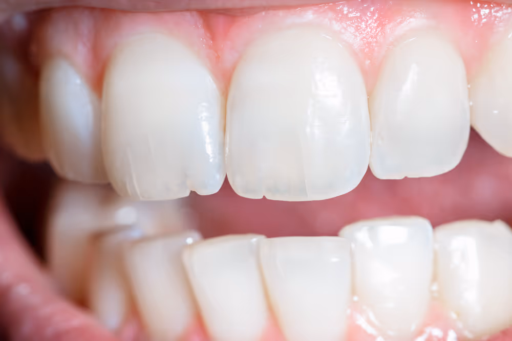 Worn down teeth