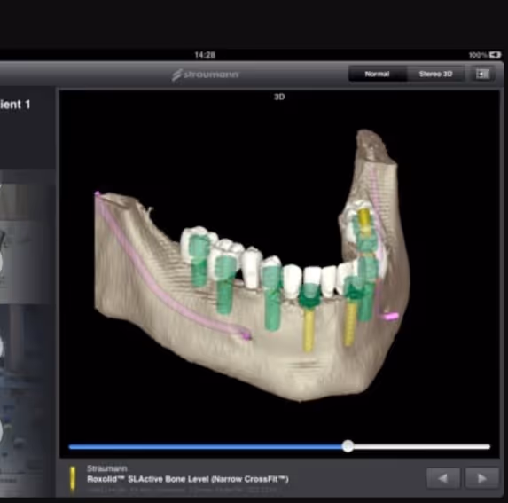 An 3d xray image of the bottom jaw showing dental implant screws