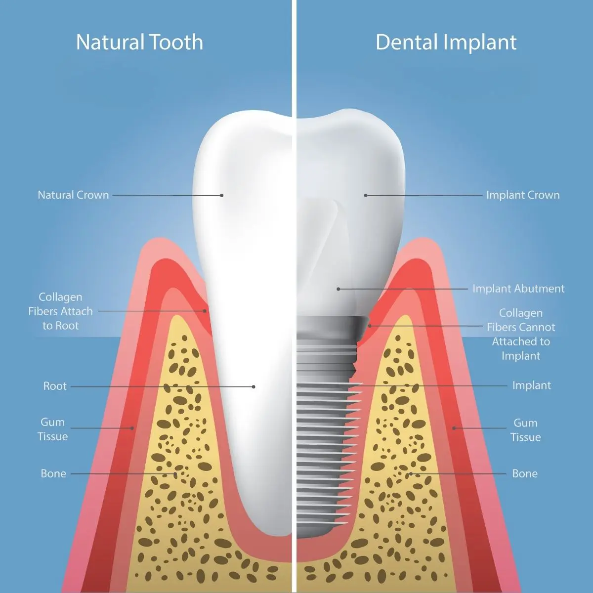 Illustration showing a dental implant and a natural tooth side by side.