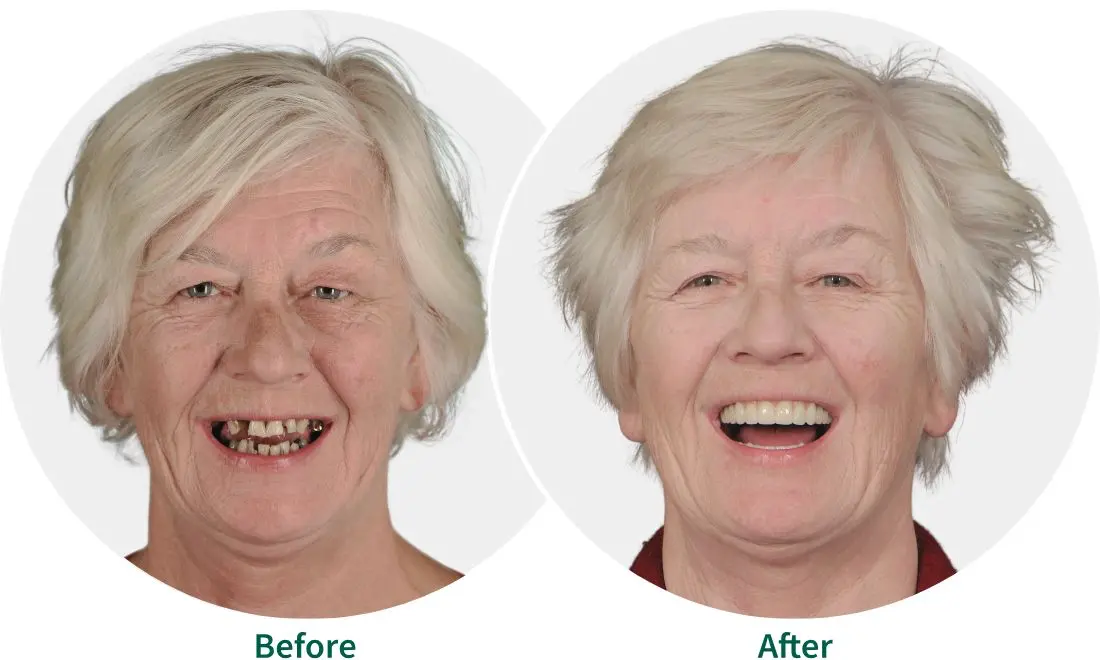 Before and after photos of an existing Great Alpine Dental patient.