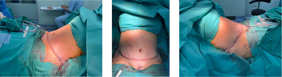 Surgery room scenes showing tummy tuck procedure.