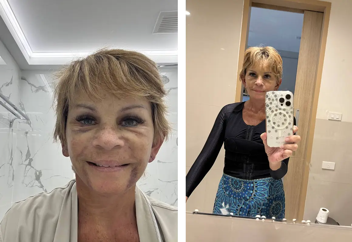 Facelift recovery progress in Thailand, 6 days and 3 weeks after surgery.