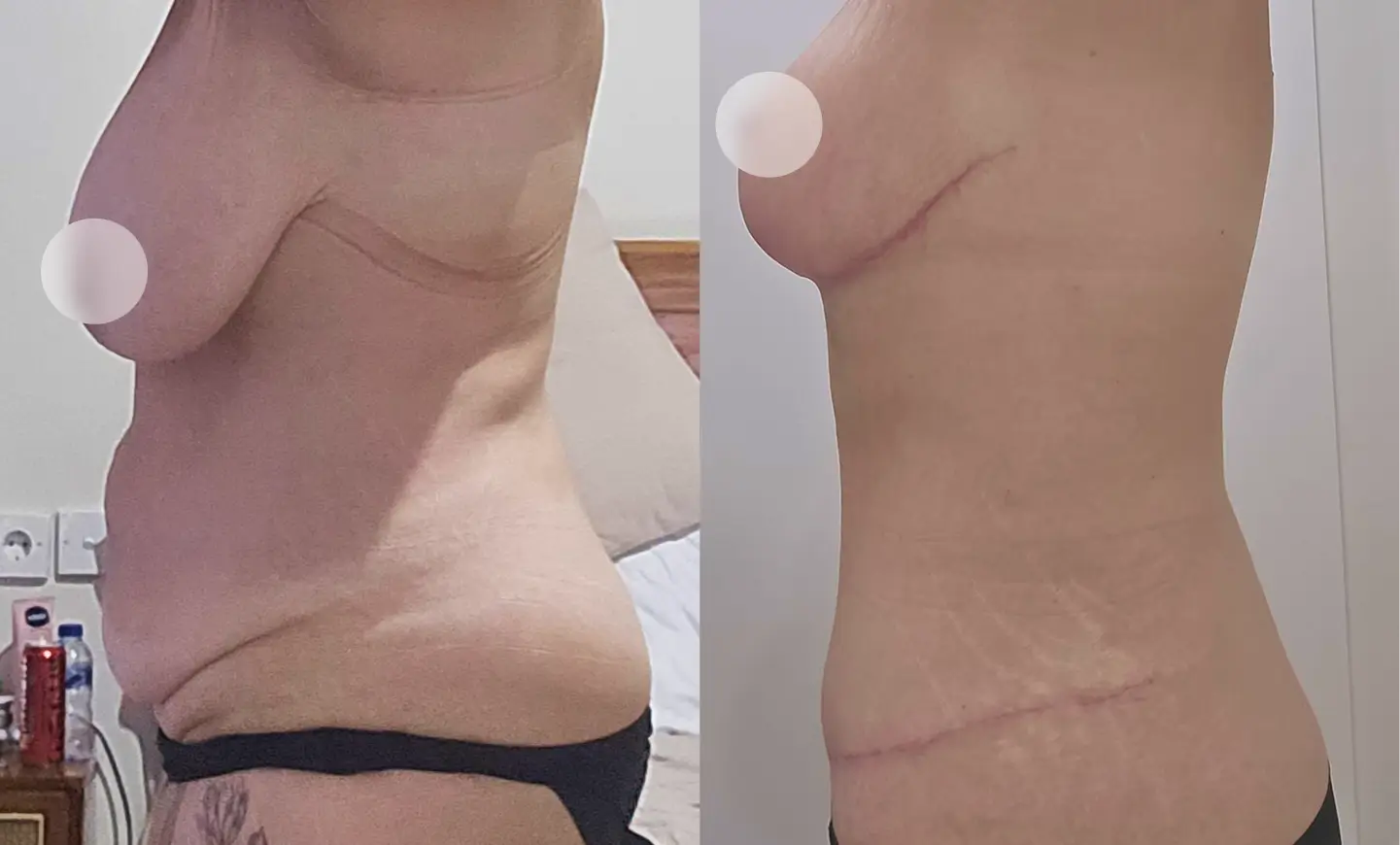 Before after of Mommy Makeover