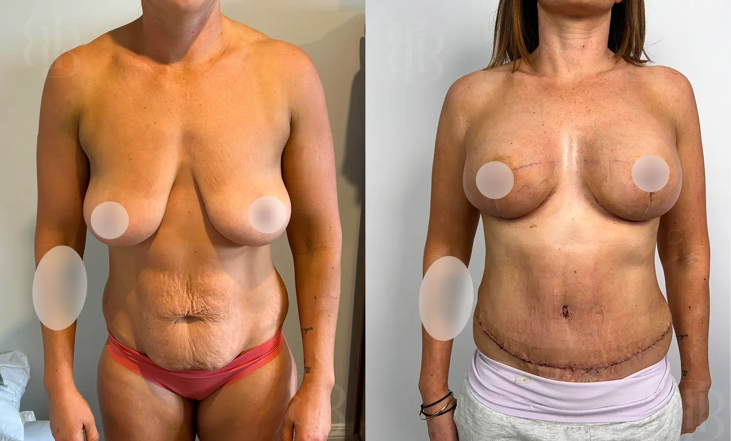 Before after of Mommy Makeover