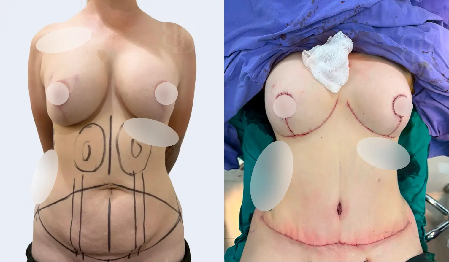 Before after of Mommy Makeover