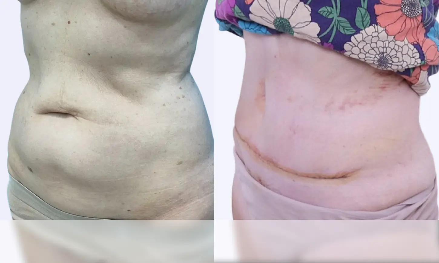 before after tummy tuck
