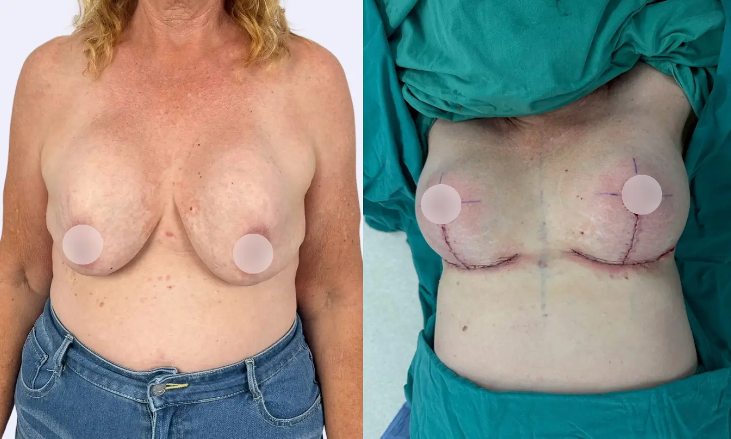 before & after breastlift