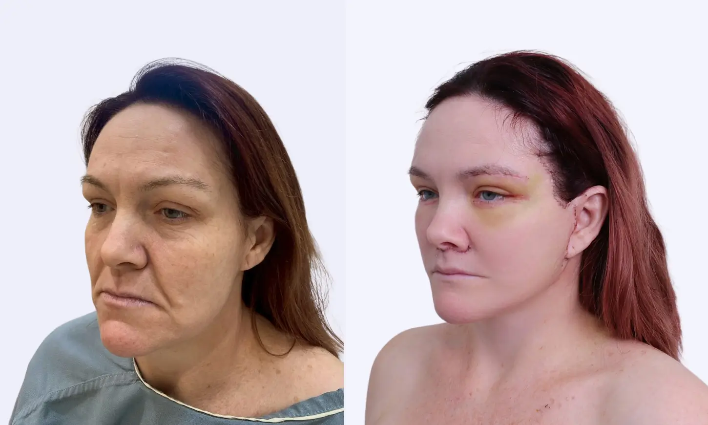 before & after facelift