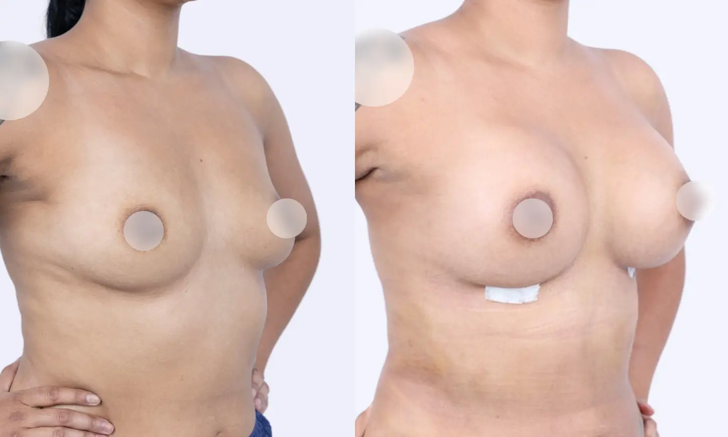 before & after breast augmentation (censored)