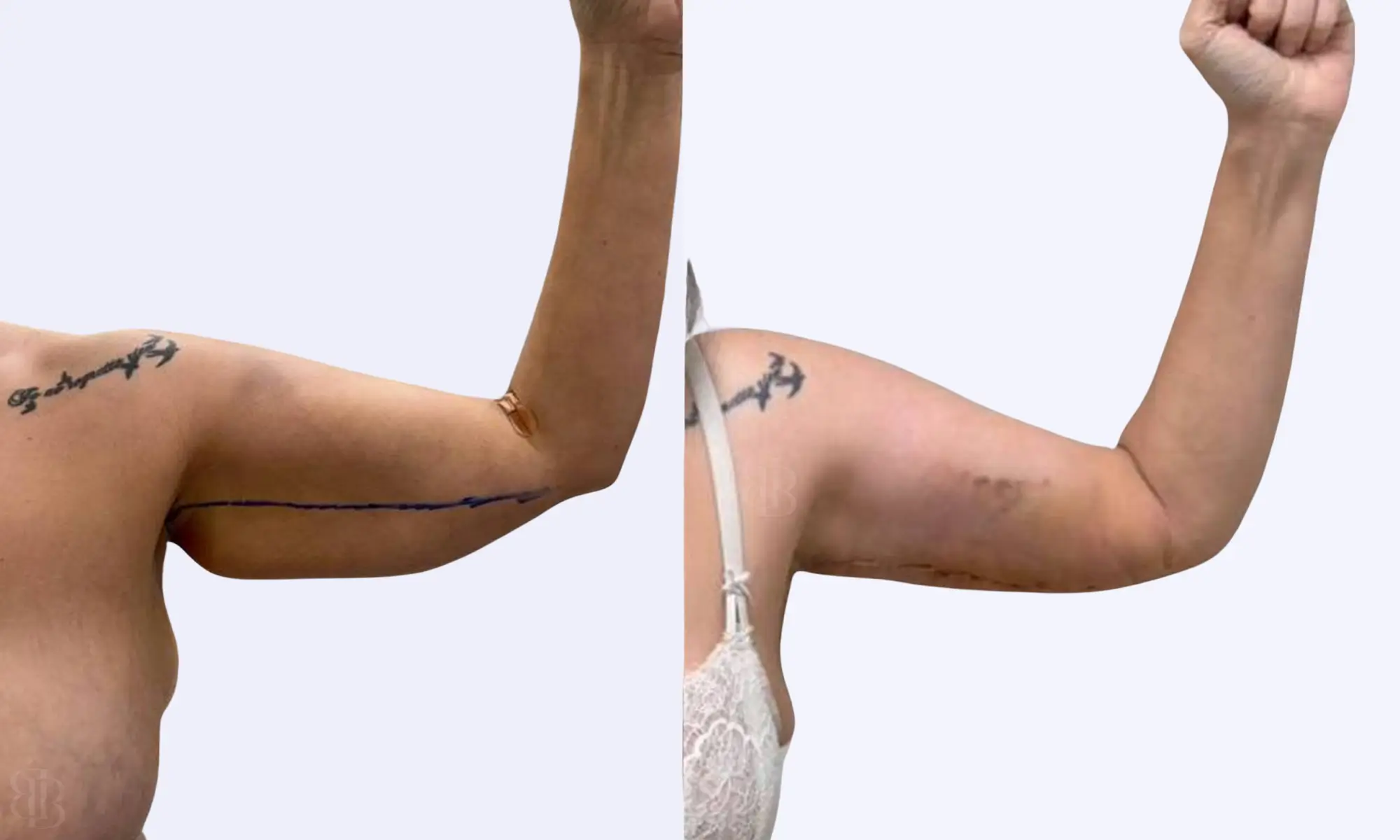 Before After of arm lift