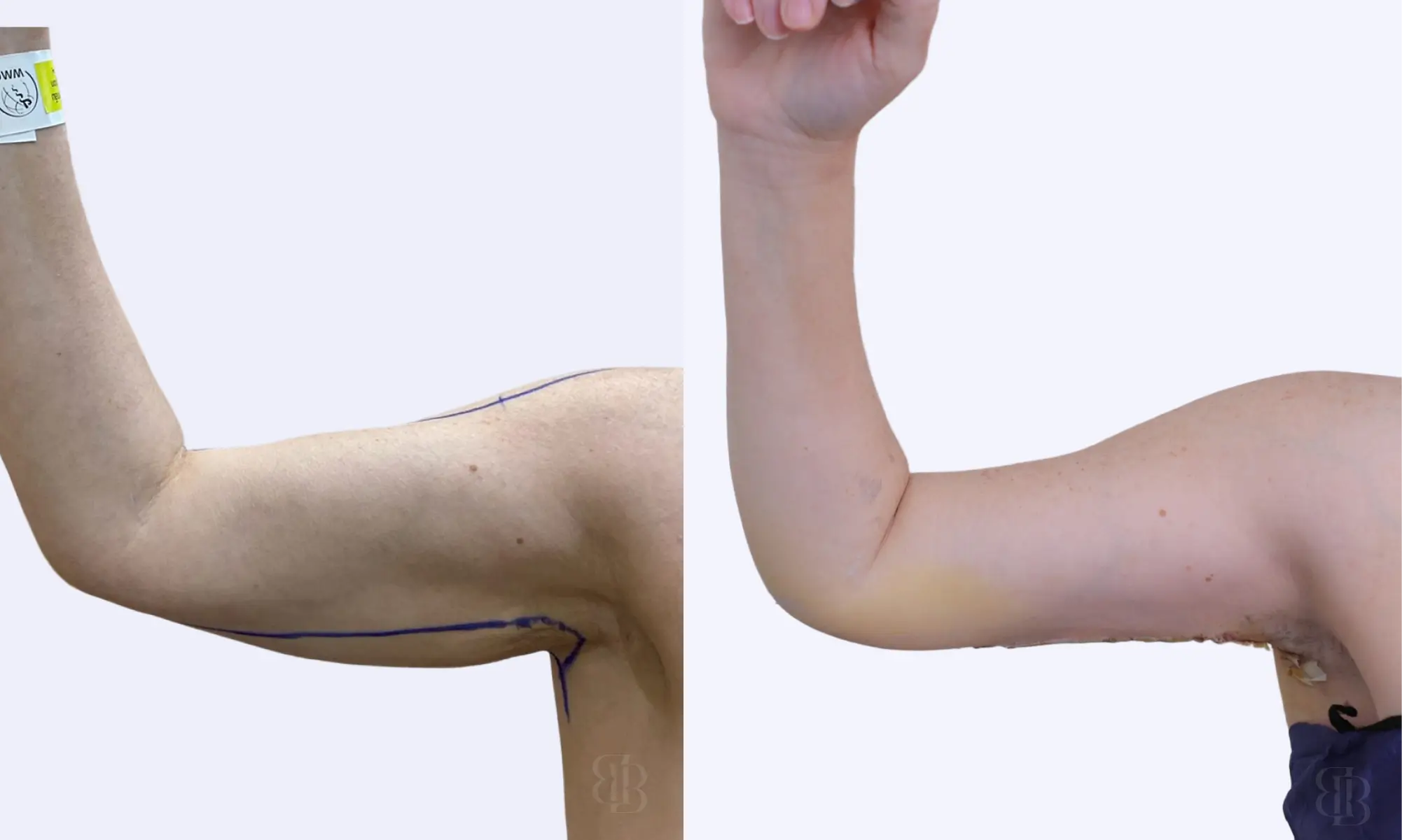 Before After of arm lift
