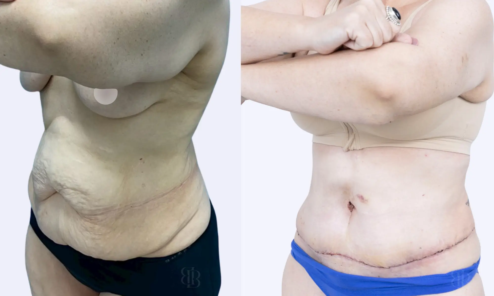 before after tummy tuck