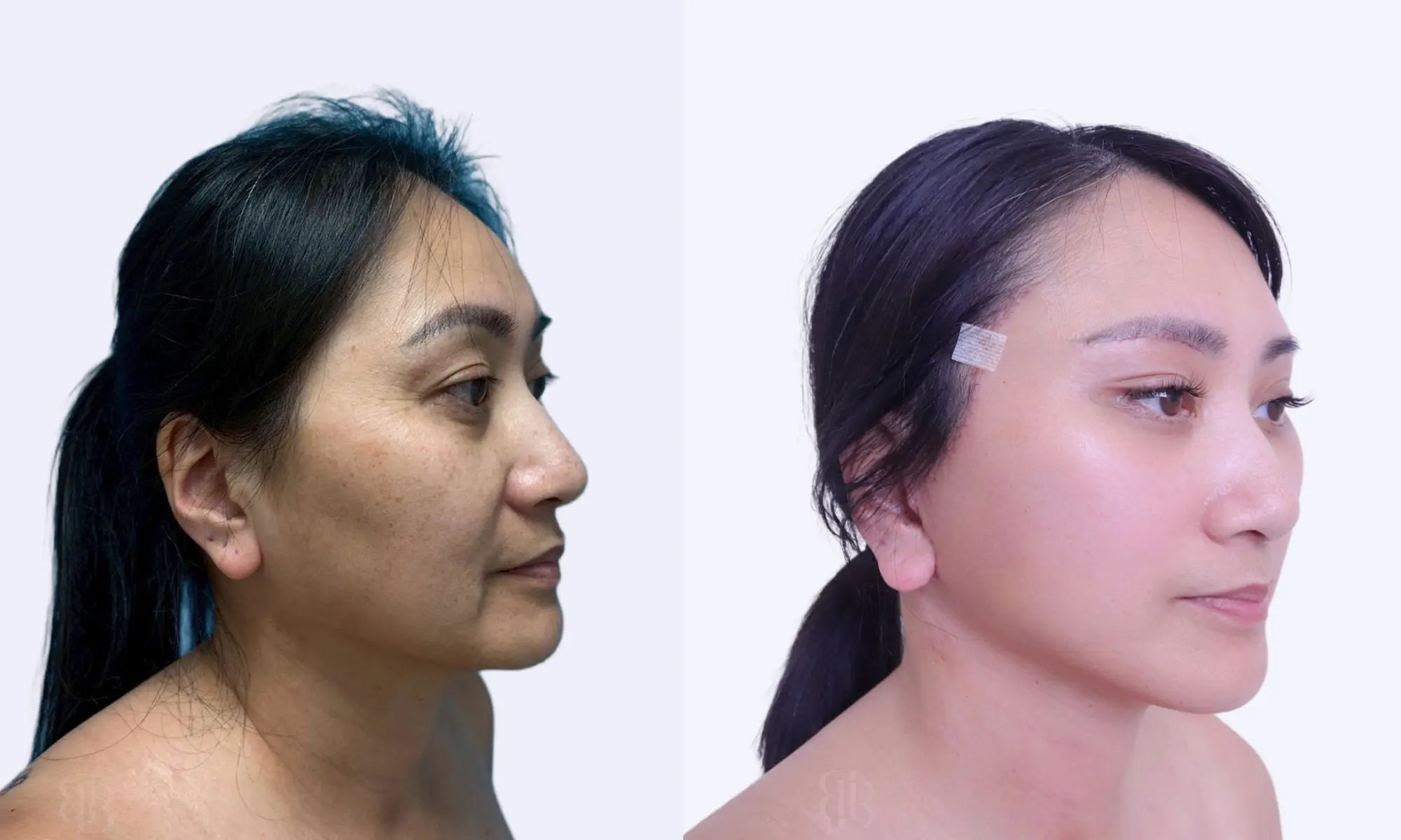 before after of facelift
