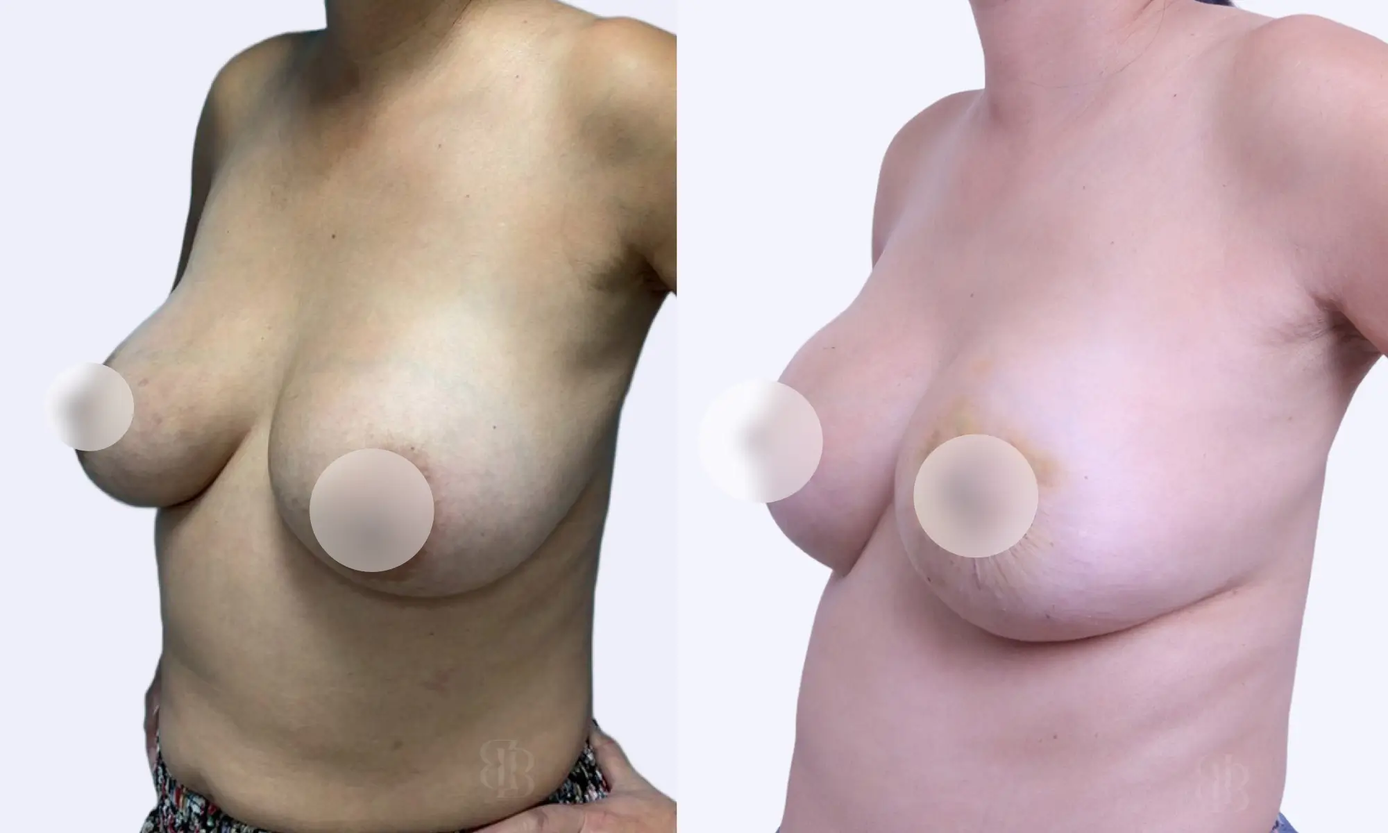 Before after of breast lift