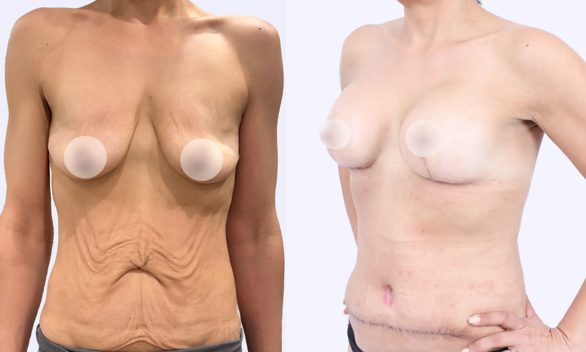 before & after of mommy makeover